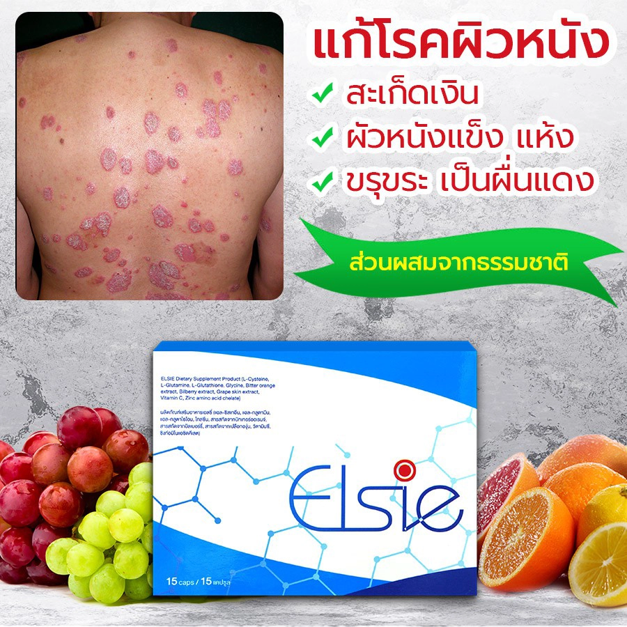 ใครควรใช้ ข้อบ่งชี้ในการใช้ยา Elsie ได้แก่